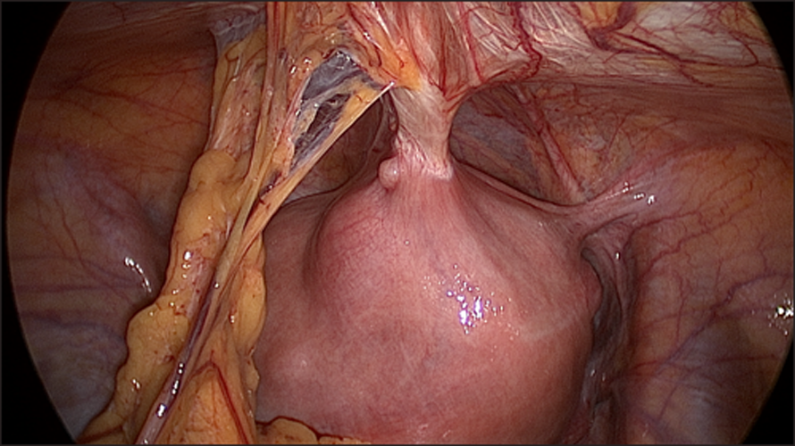 Adhesiolysis before hysterectomy