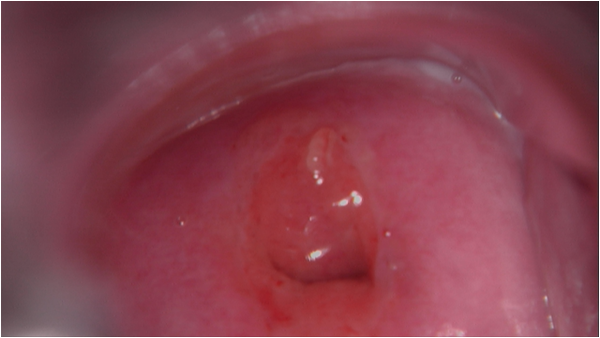 Colposcopy