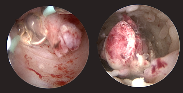 endometrial carcinoma